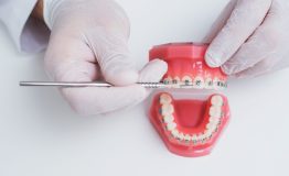 doctor orthodontist shows how the system of braces on teeth is arranged