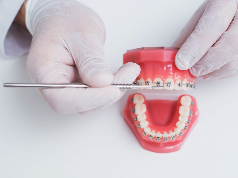 doctor orthodontist shows how the system of braces on teeth is arranged