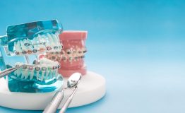 dental tools and orthodontic model.