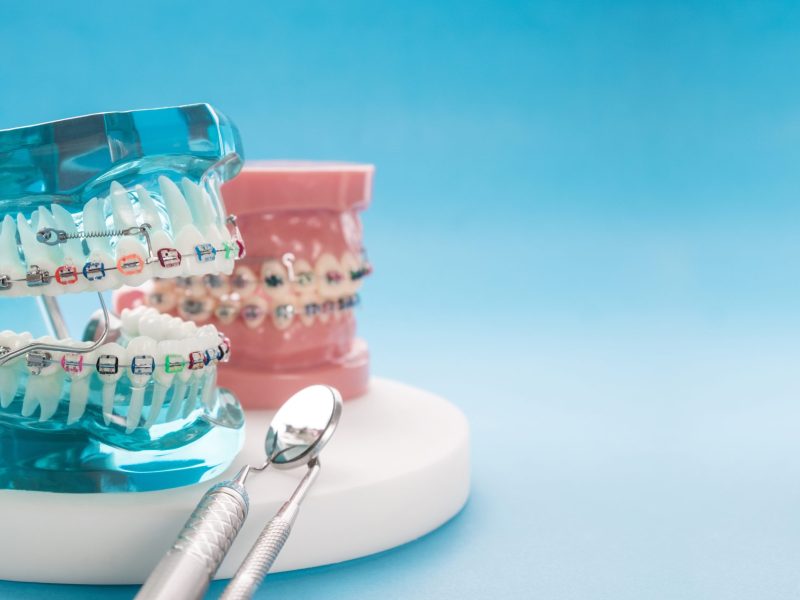 dental tools and orthodontic model.